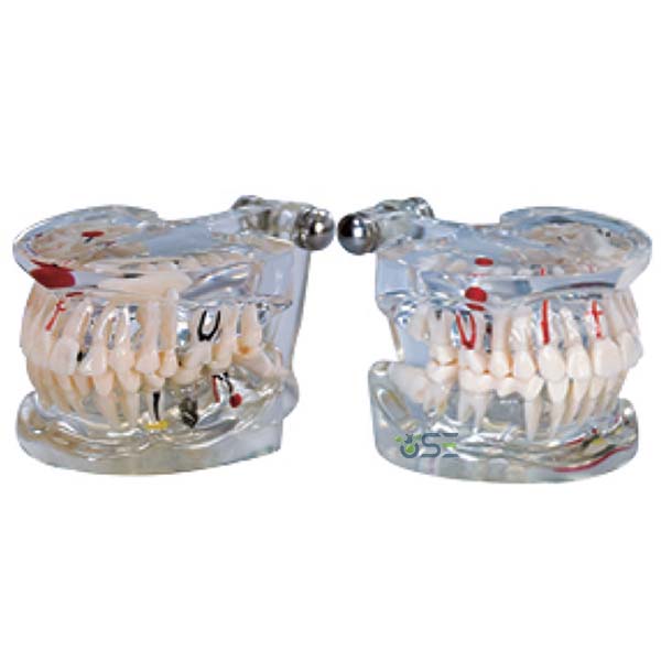 Pathology Teeth Model