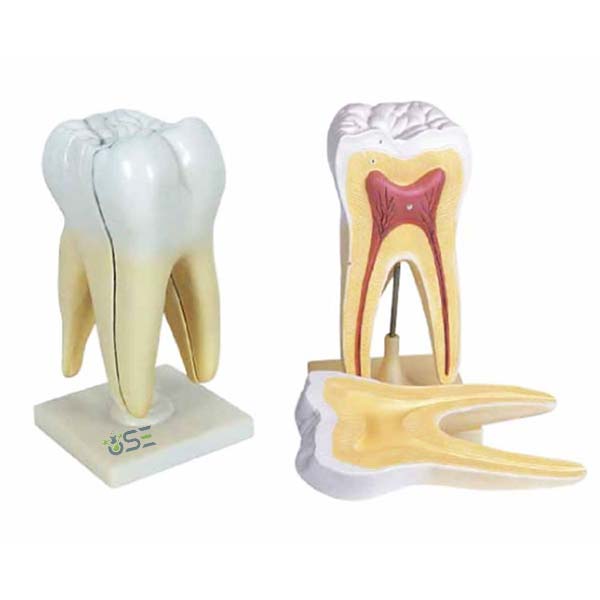 Triple Root Molar with Caries Model