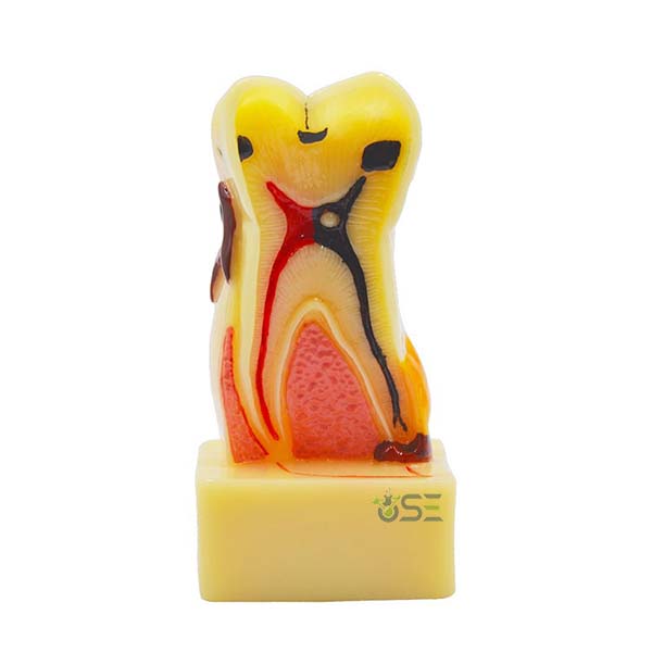 Disease Teeth Model